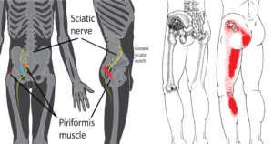 Inversion Therapy for Sciatica - Being Straight, Strong and Healthy by ...